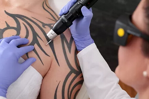 Ingleby Barwick Hub Gelous Beauty and Laser - Tattoo Removal